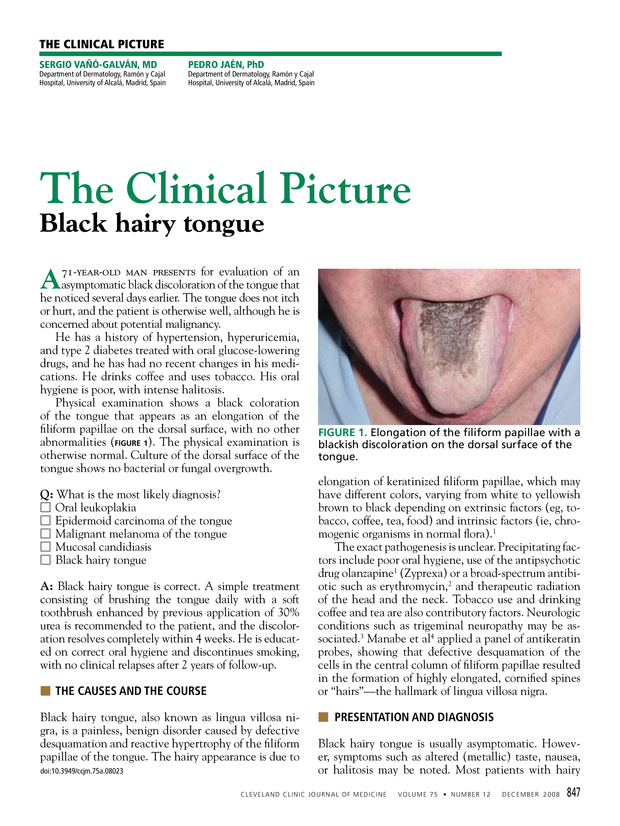 Black tongue causes and treatments  Bauer Smiles