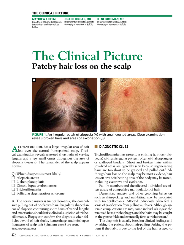 Patchy hair loss on the scalp | Cleveland Clinic Journal of Medicine Patchy hair loss on the scalp | Cleveland Clinic Journal of Medicine
