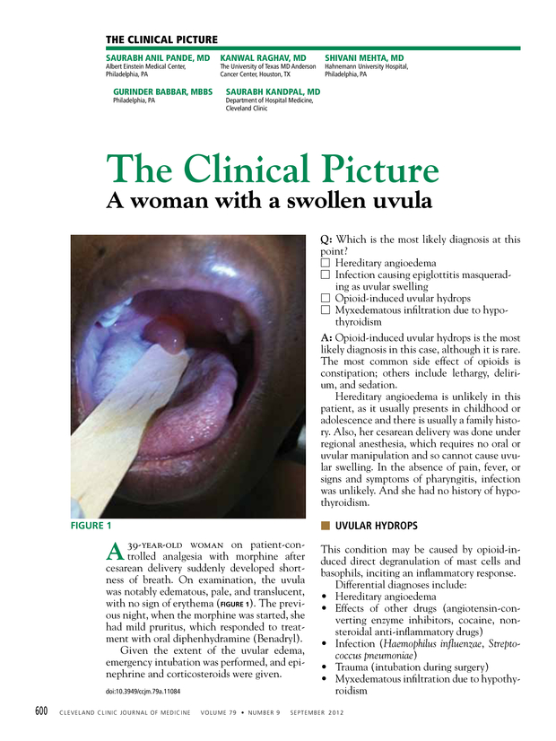 A woman with a swollen uvula Cleveland Clinic Journal of Medicine