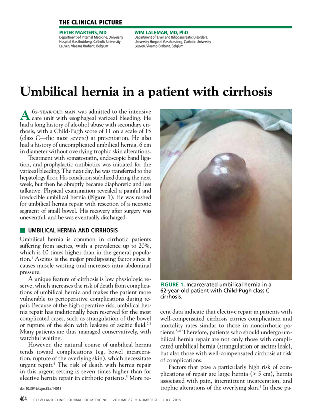 Umbilical Hernia Causes and Treatment, by Kristensmith Taylor