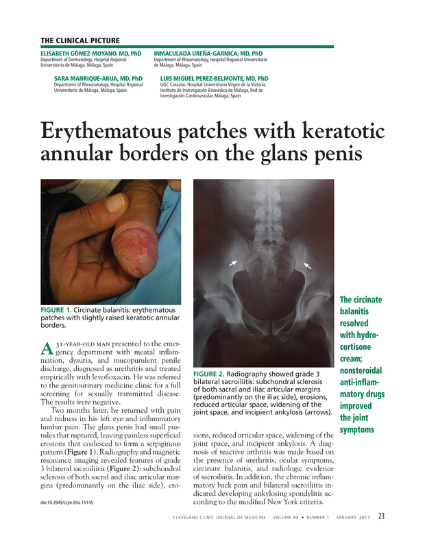 Erythematous Patches With Keratotic Annular Borders On The Glans Penis 