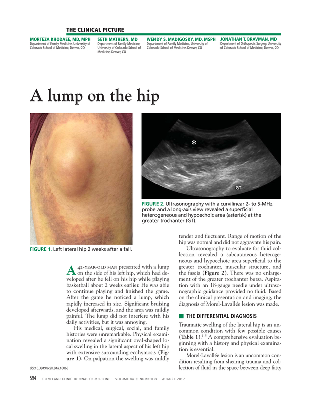 A Lump On The Hip Cleveland Clinic Journal Of Medicine a-lump-on-the-hip-cleveland-clinic-journal-of-medicine