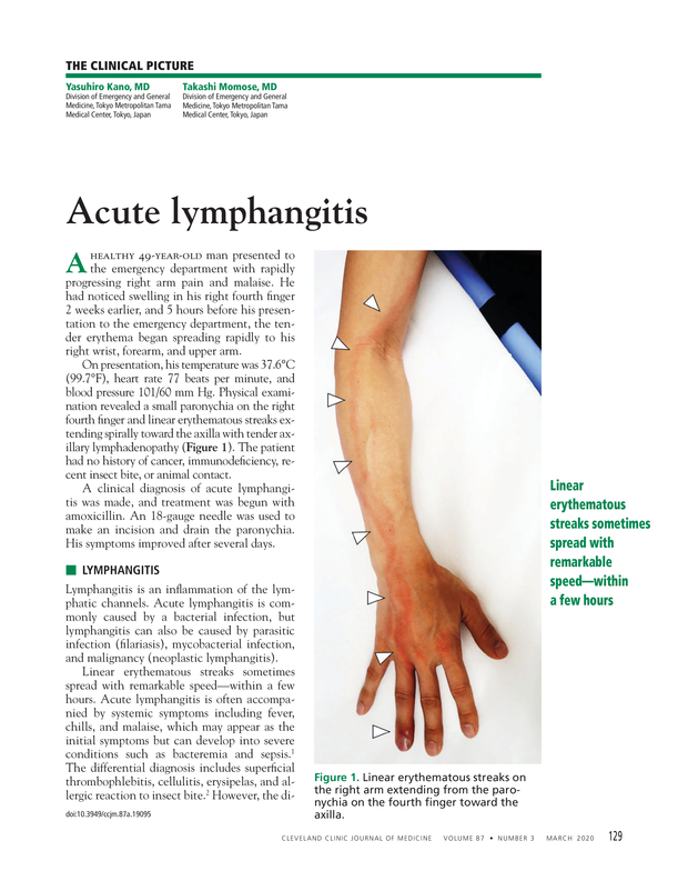 acute lymphangitis of left upper arm. icd-10-cm code