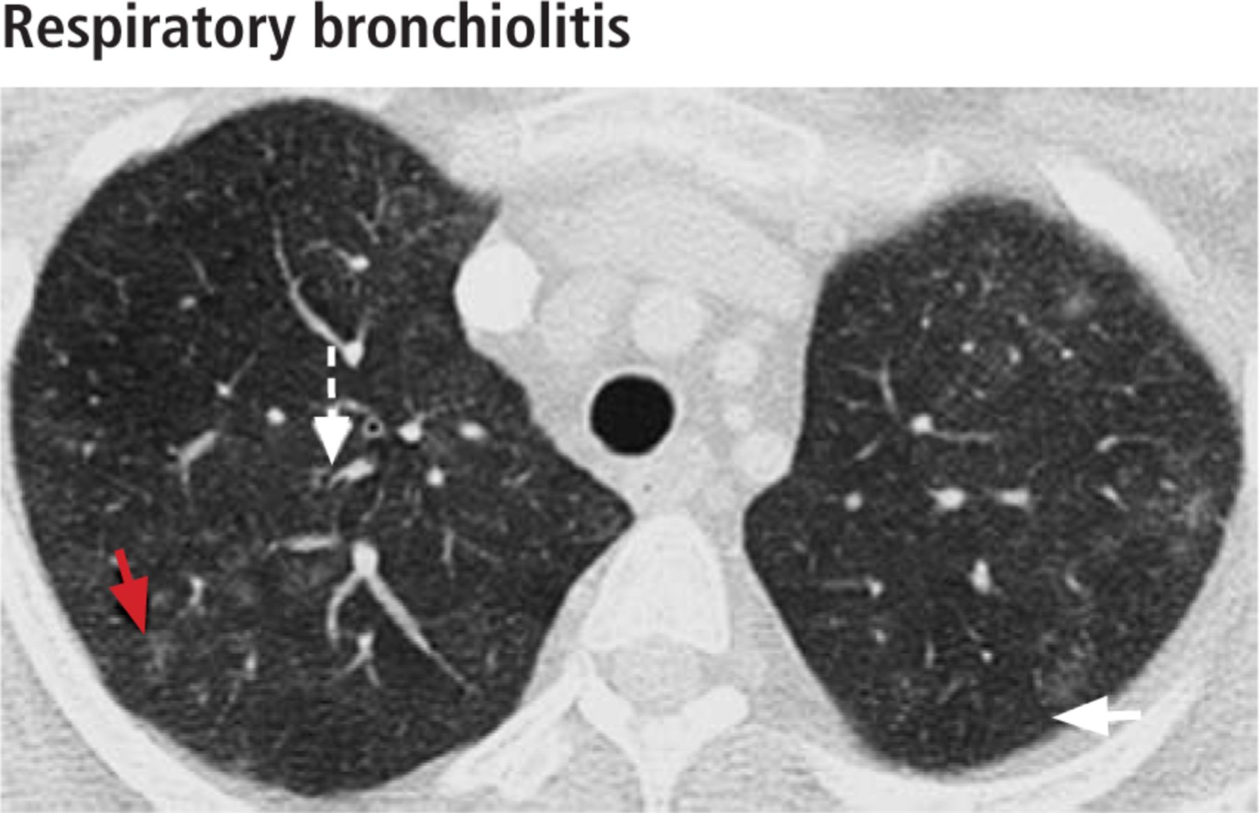 multicystic peritoneal mesothelioma pathology outlines