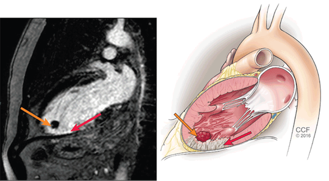 Left ventricular thrombosis can still complicate acute myocardial infarction | Cleveland Clinic ...