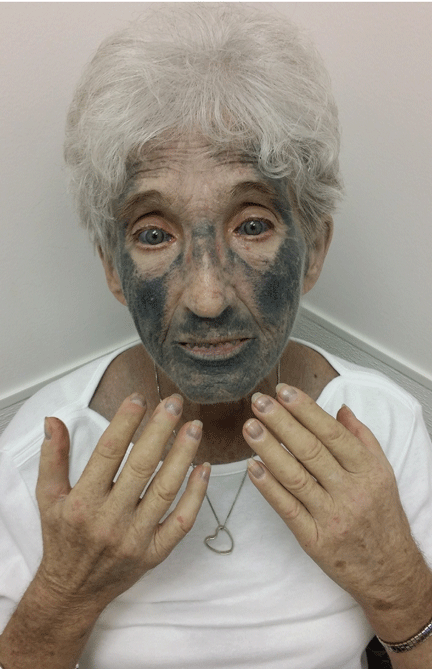 Skin Discoloration from Amiodarone