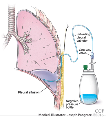 mesothelioma cancer research canada