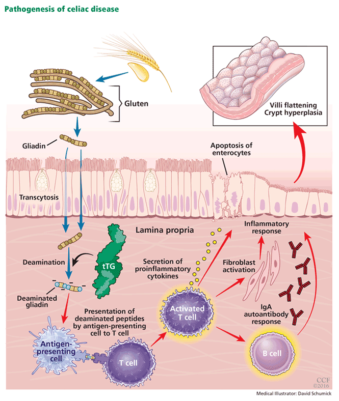 Celiac Chart