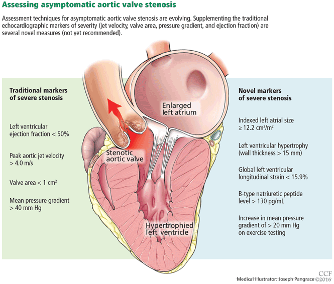 Enlarged Aorta Valve