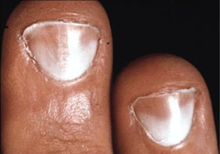 Fingernail changes in IBS, Gluten Sensitivity and Celiac Disease - Amy  Burkhart, MD, RD