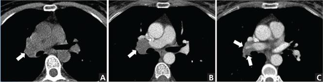 When does chest CT contrast Cleveland Journal of Medicine