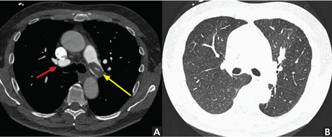 When does chest CT contrast Cleveland Journal of Medicine