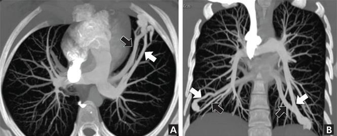 Black: high density of contrast medium. White: low density of contrast