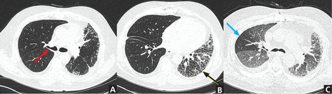 When does chest CT contrast Cleveland Journal of Medicine