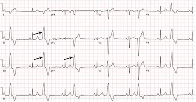 Premature Ventricular Contractions Types