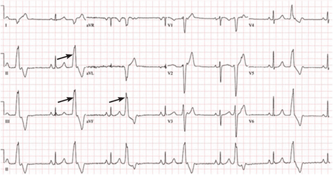 Premature Ventricular Contractions Reassure Or Refer Cleveland Clinic Journal Of Medicine