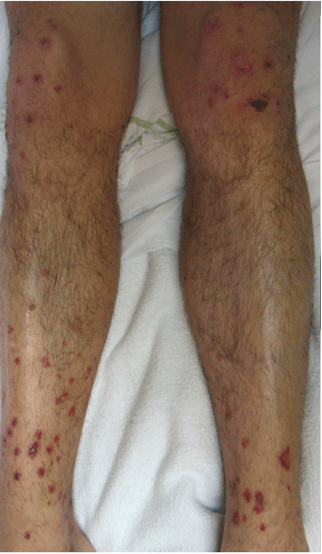 A Man With Hiv And Papules And Nodules On The Knees Cleveland Clinic