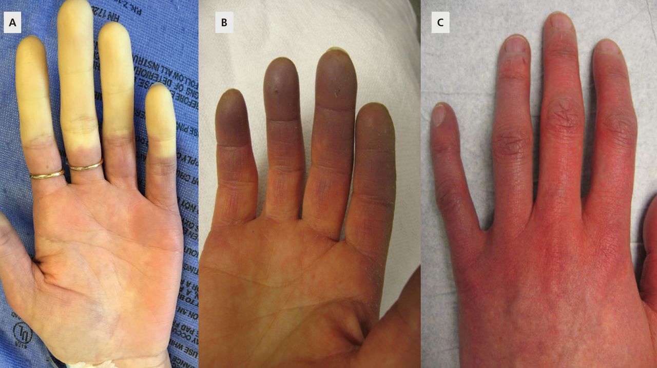 Treating Raynaud phenomenon: Beyond staying warm | Cleveland