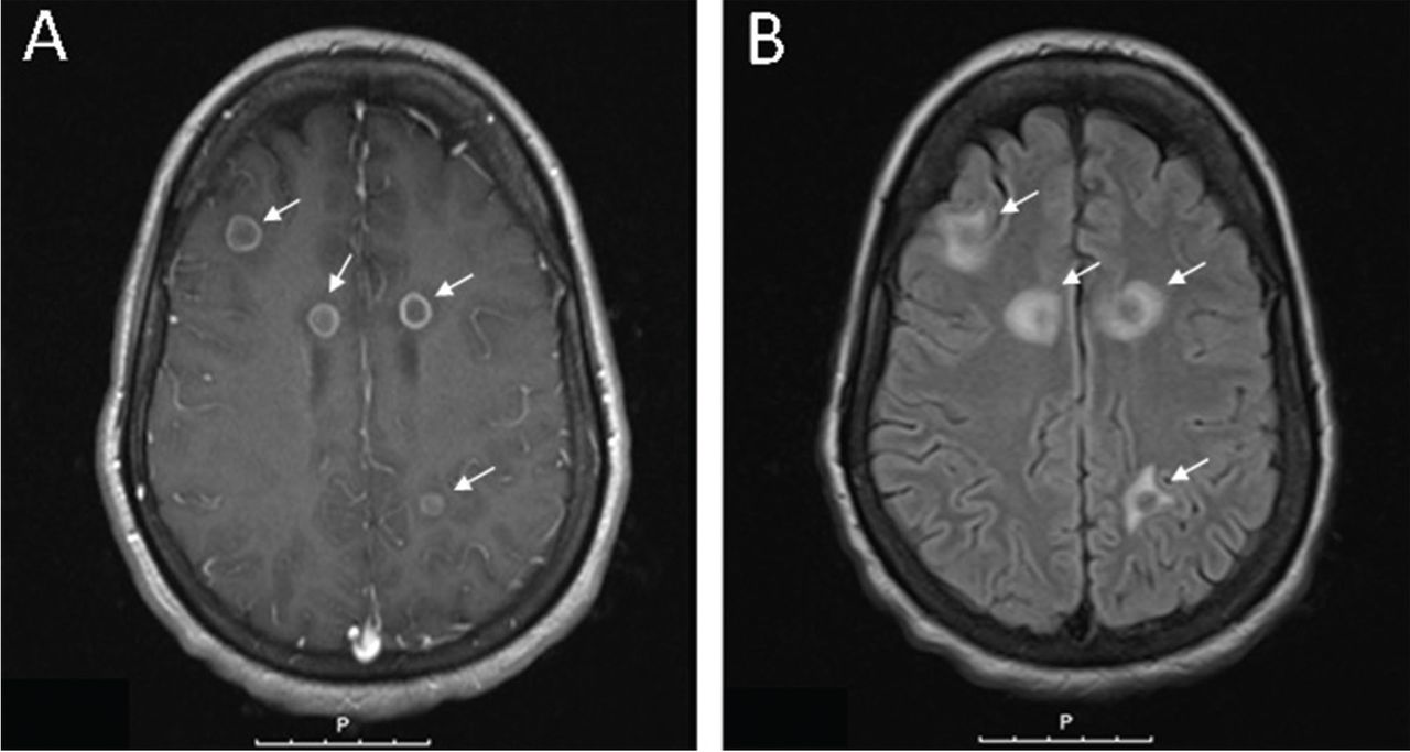 Ring enhancing brain lesions in a patient with Acquired Immunodeficiency  Syndrome (AIDS): a diagnostic dilemma | BMJ Case Reports