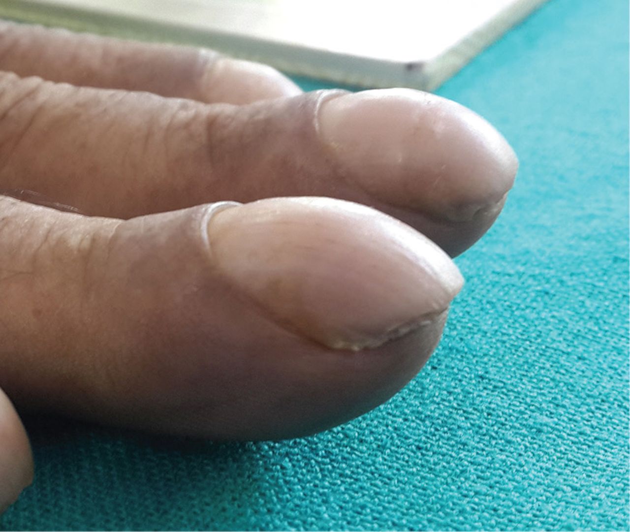 How Does Cystic Fibrosis Cause Clubbing of Fingers and Toes?