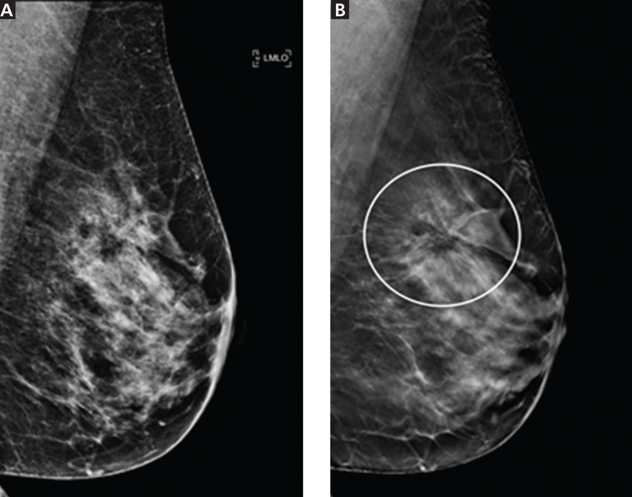 Mammogram Images