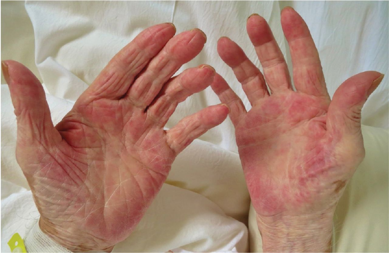 Palmar erythema as a sign of cancer | Cleveland Clinic Journal of ...