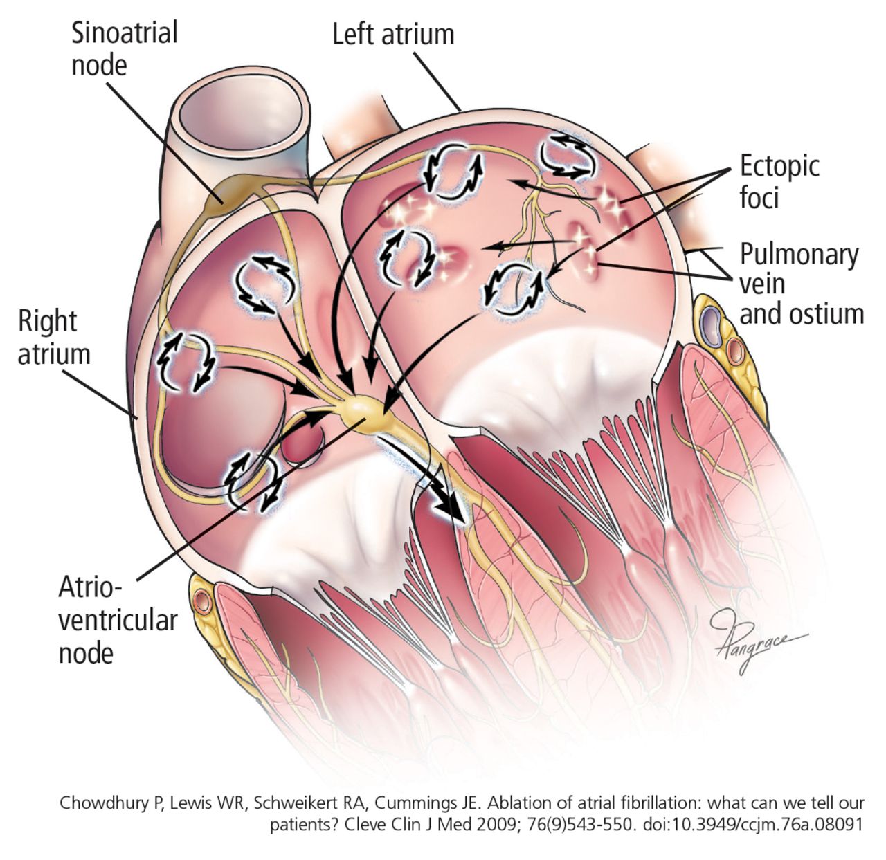 Ablation Of Atrial Fibrillation Facts For The Referring Physician