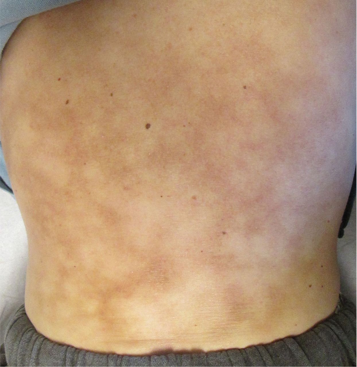 Erythema on sale ab igne