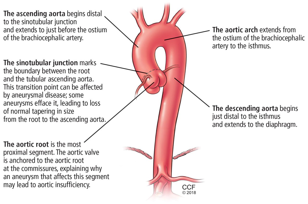 Thoracic Aortic Aneurysm How To Counsel When To Refer Cleveland