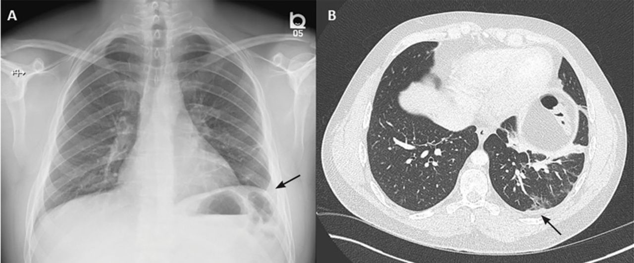 Pneumonia With Pleural Effusion