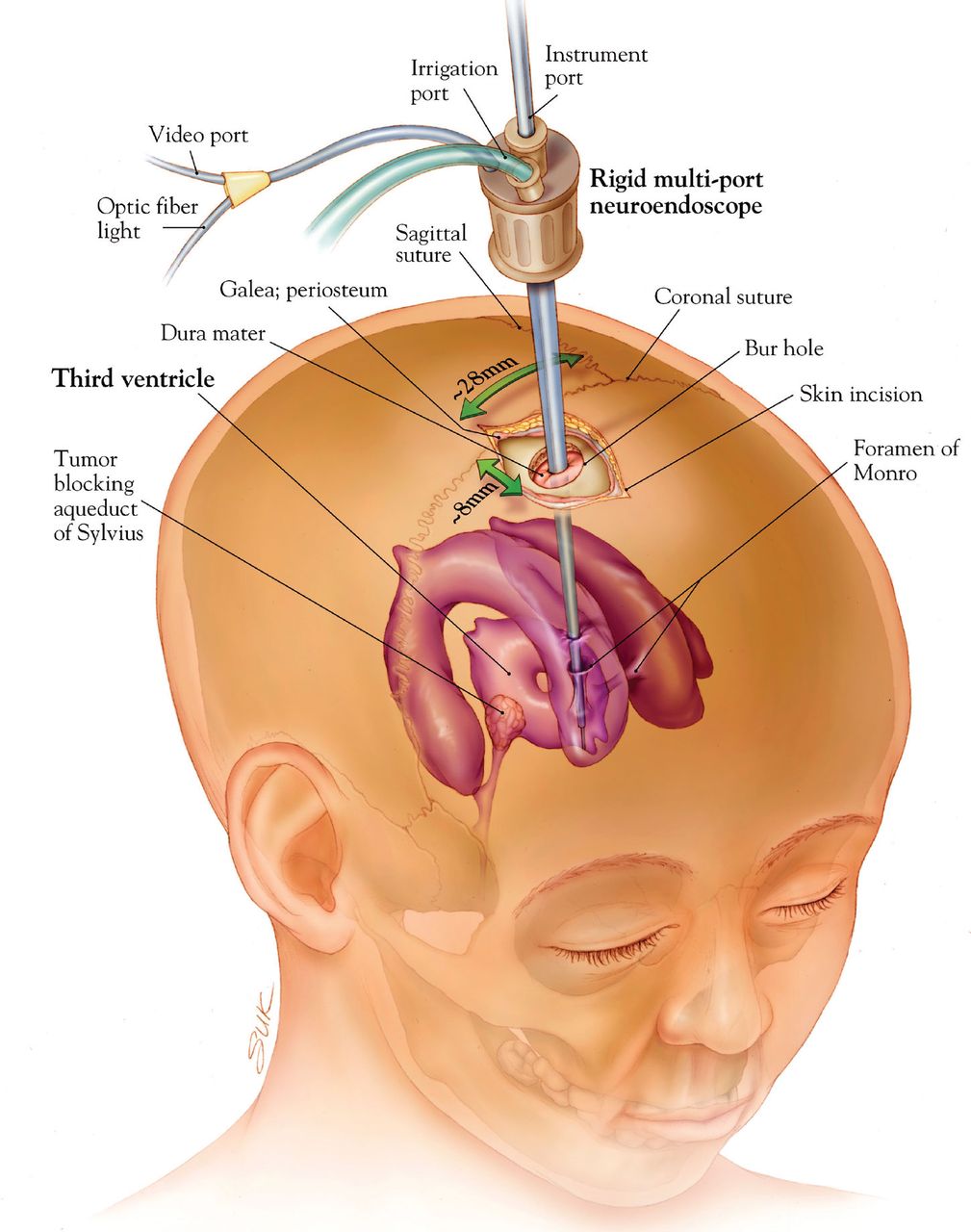 Endoscopic vs. Open Back Surgery