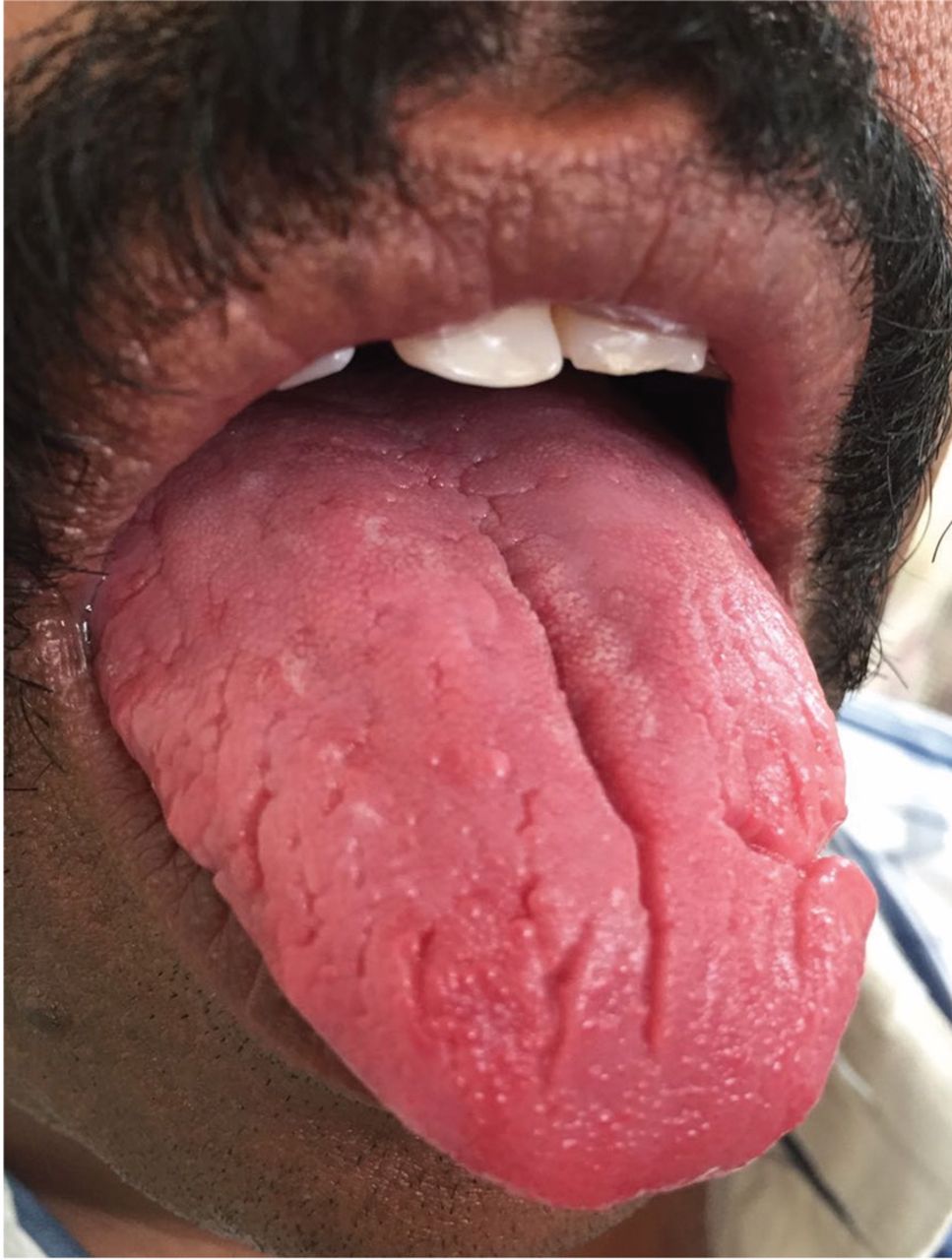 Fissured Tongue Cleveland Clinic Journal Of Medicine 