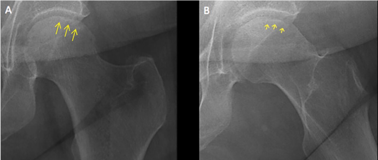 Osteonecrosis Of The Hip