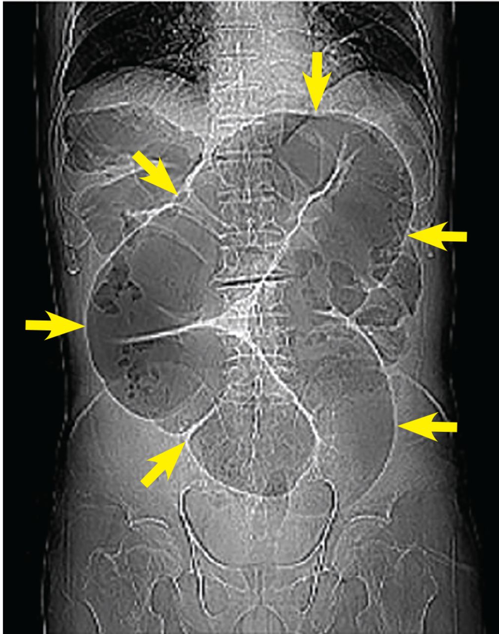 Sigmoid Volvulus Coffee Bean Sign Whirl Sign Cleveland Clinic Journal Of Medicine