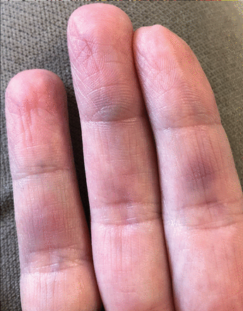 Paroxysmal finger hematoma | Cleveland Clinic Journal of Medicine