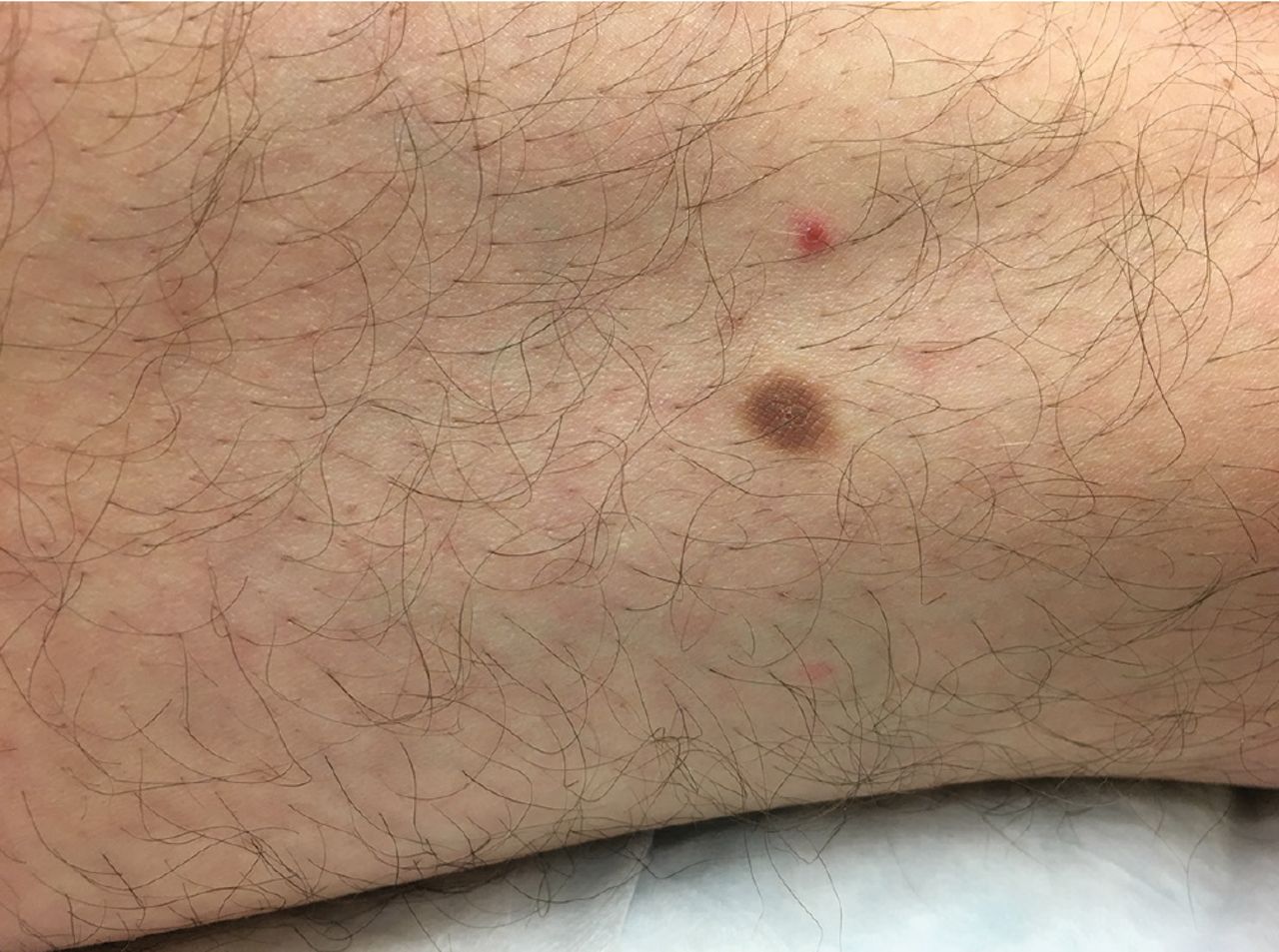 Firm lesion on the lateral thigh  Cleveland Clinic Journal of Medicine