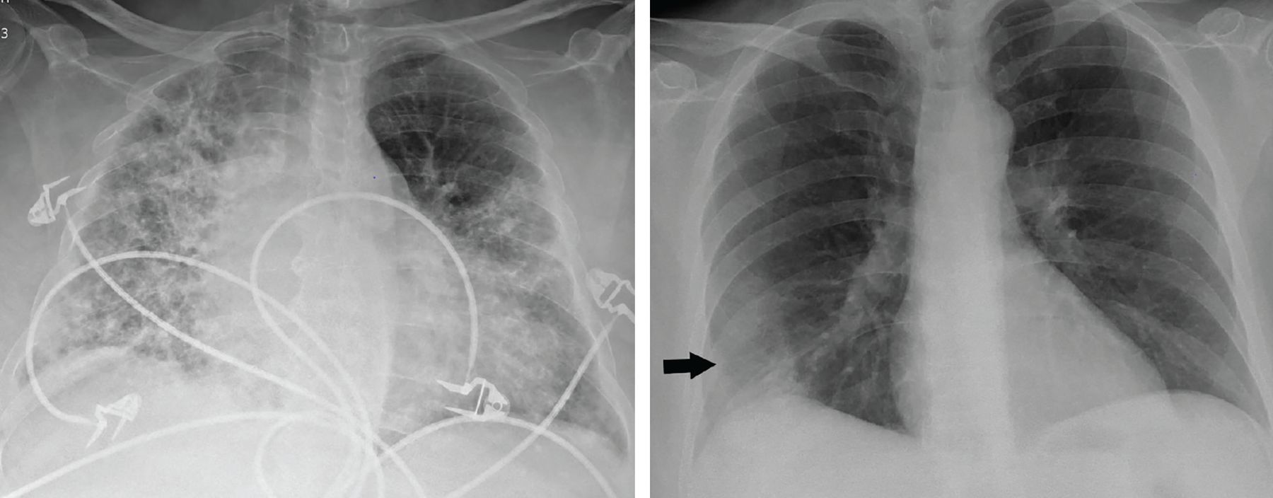 Pneumonia bilateral covid