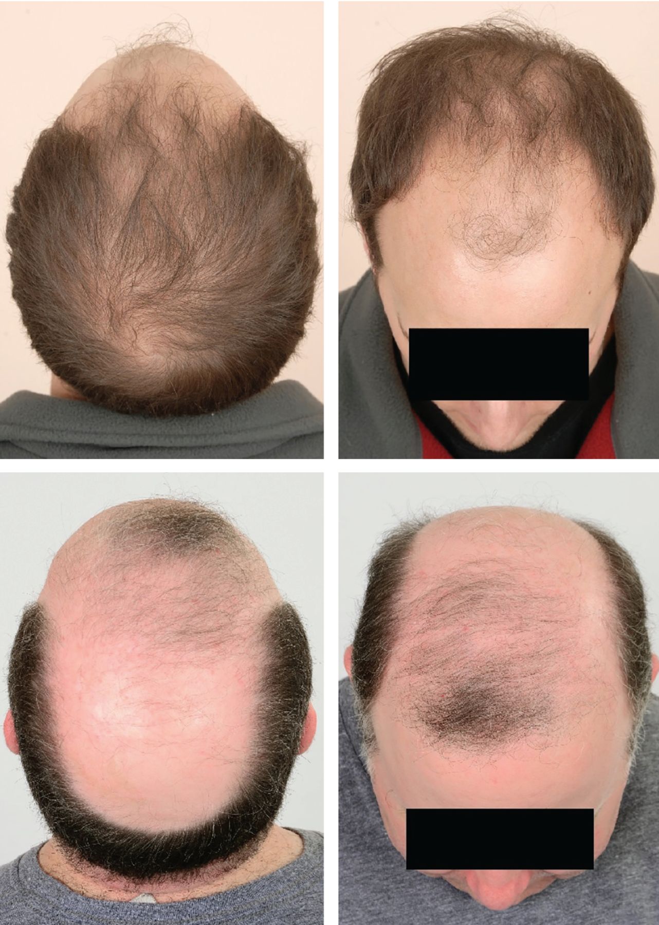 How Androgenetic Alopecia Differs in Men and Women  Everyday Health