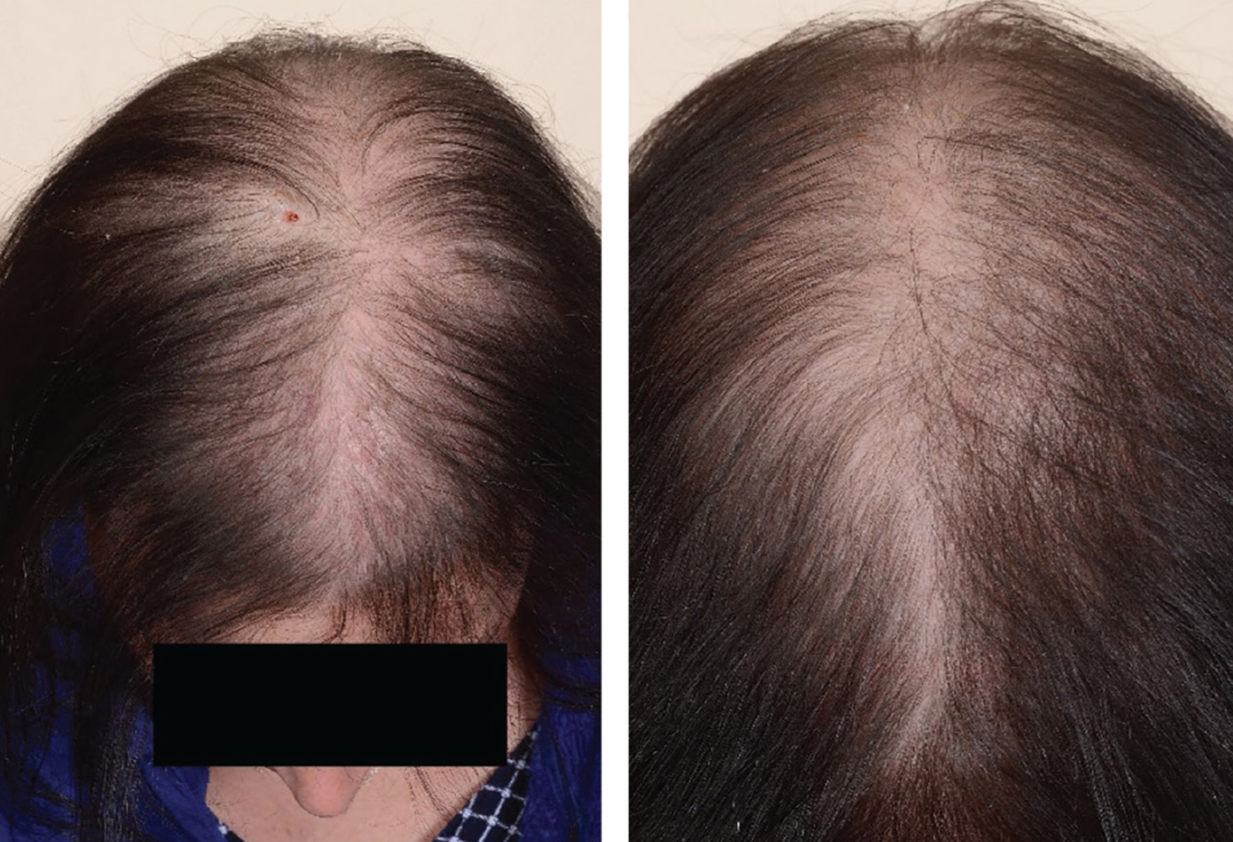 Ask the Plastic Surgeon Thinning hair in women