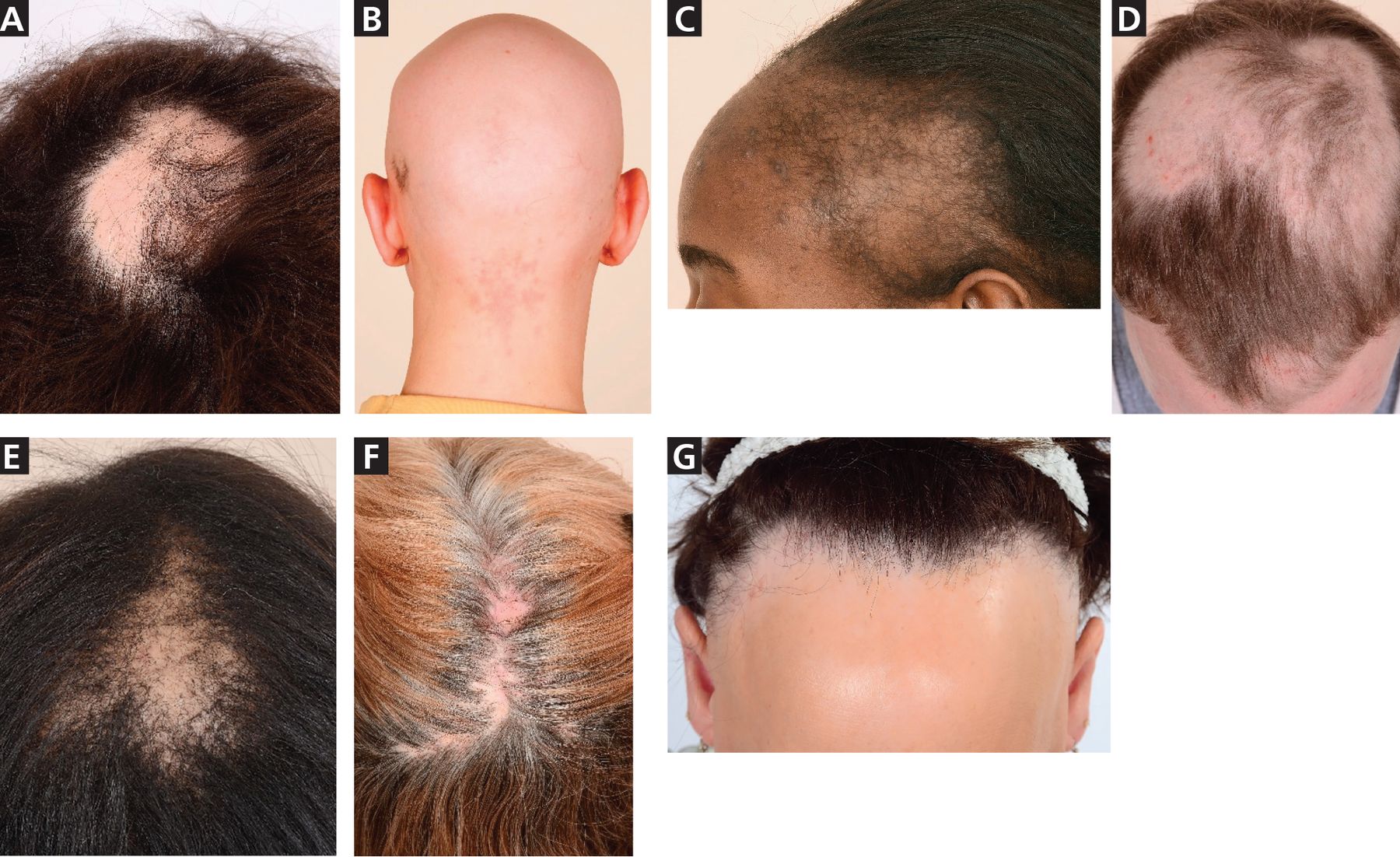 Androgenic alopecia  Insparya