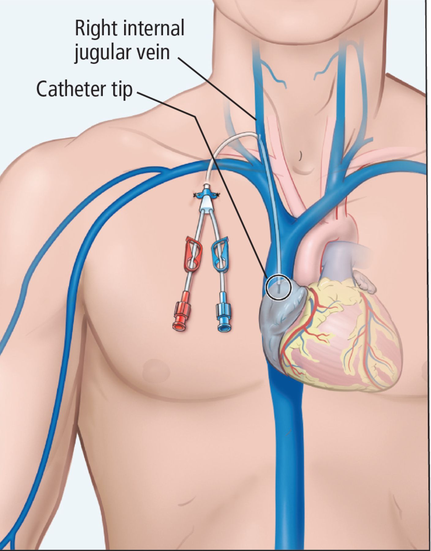 Can I Place A Peripherally Inserted Central Catheter In My Patient With