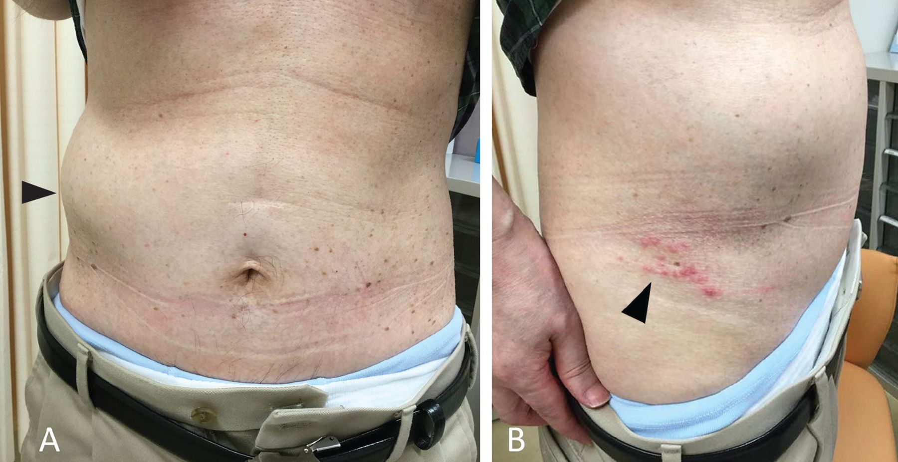 Ce cauzează umflături în partea dreaptă jos a abdomenului? Ce cauzează umflături în partea dreaptă jos a abdomenului?