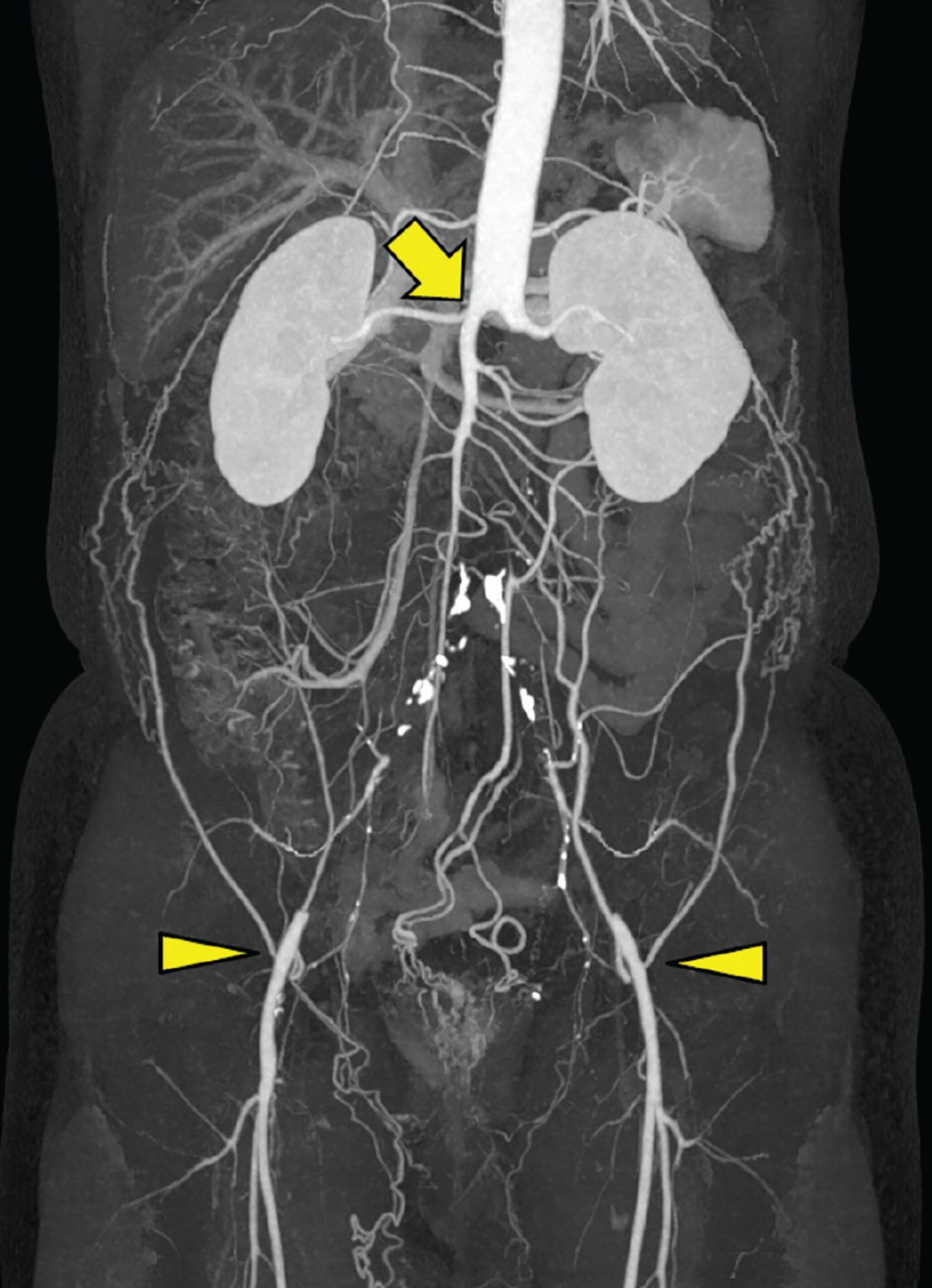 Leriche syndrome | cleveland clinic journal of medicine