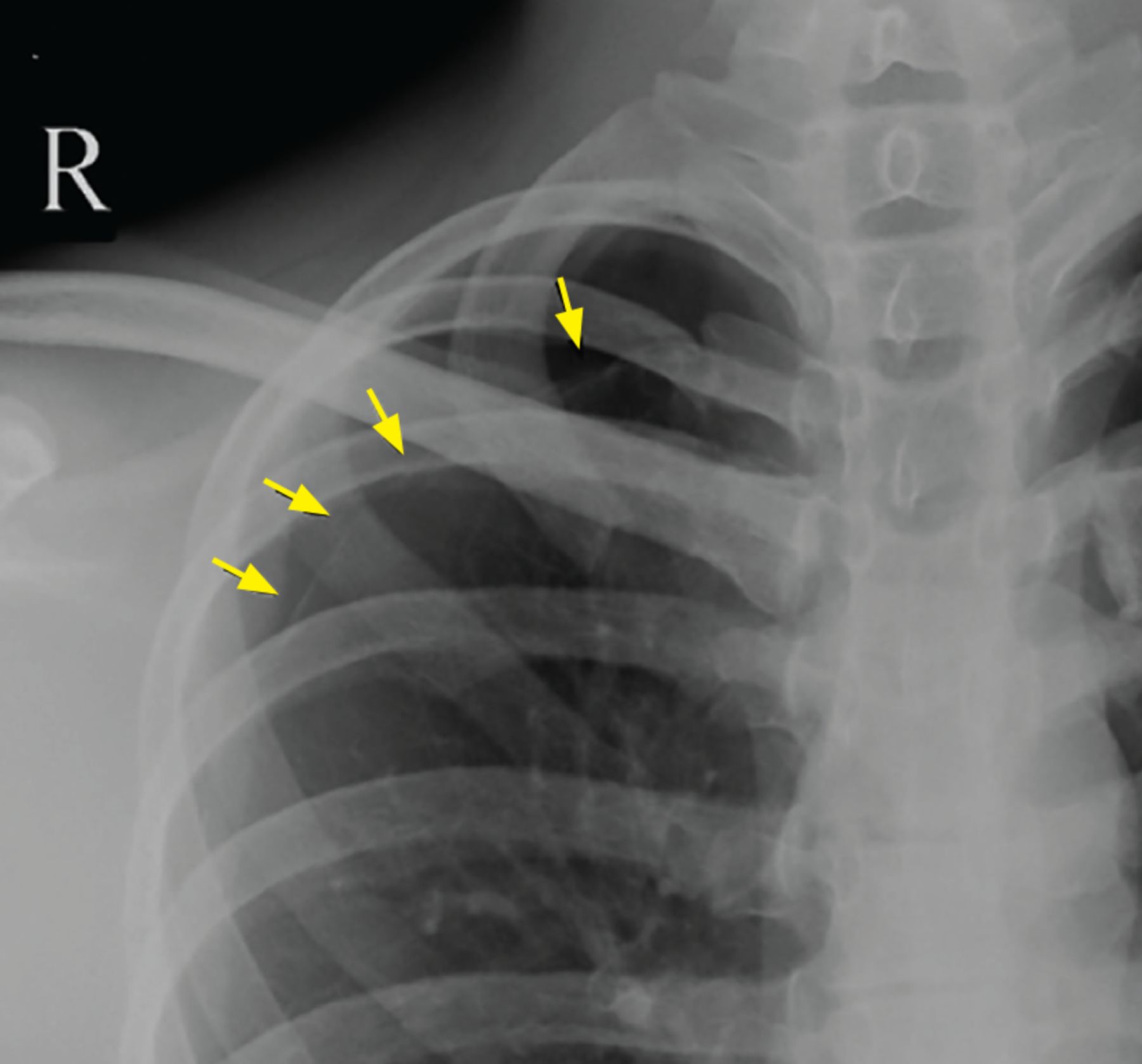 An uncommon cause of chest pain  Cleveland Clinic Journal of Medicine