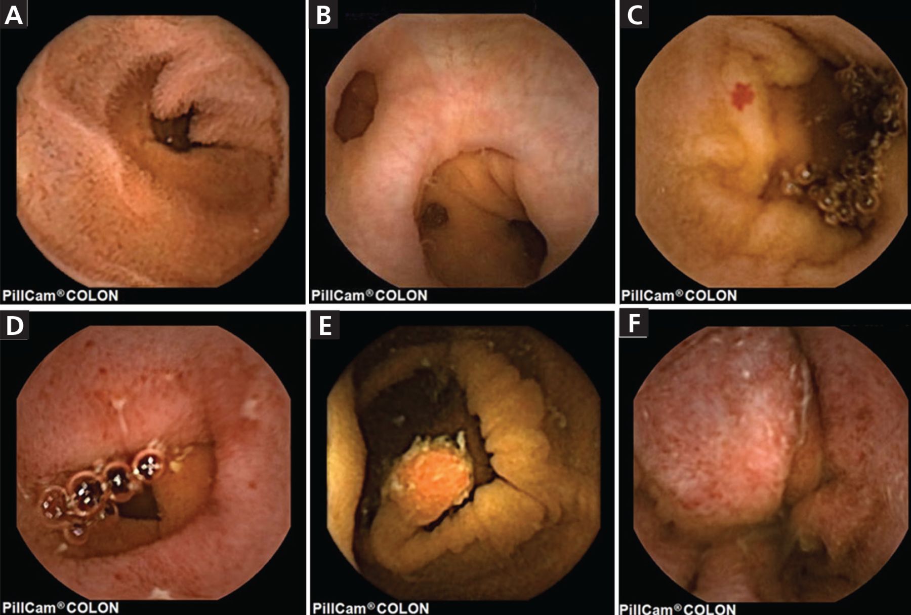 Capsule Endoscopy - Gastrointestinal Society