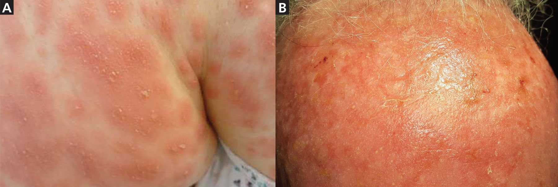 diffuse erythematous rash