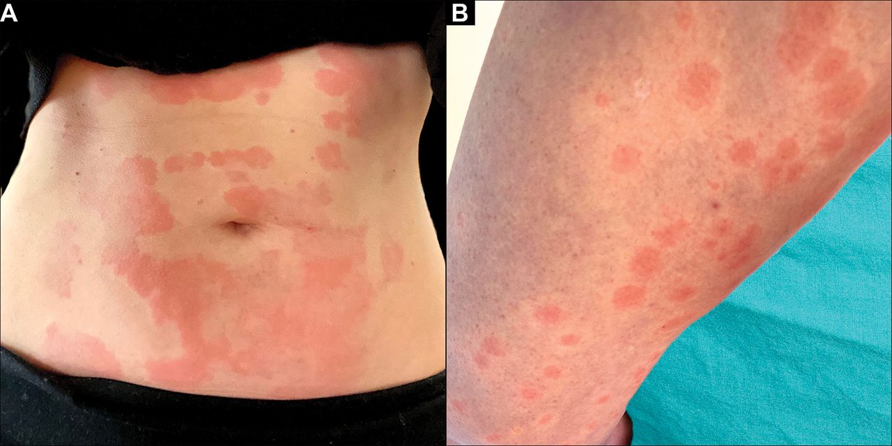 covid rash pictures in adults