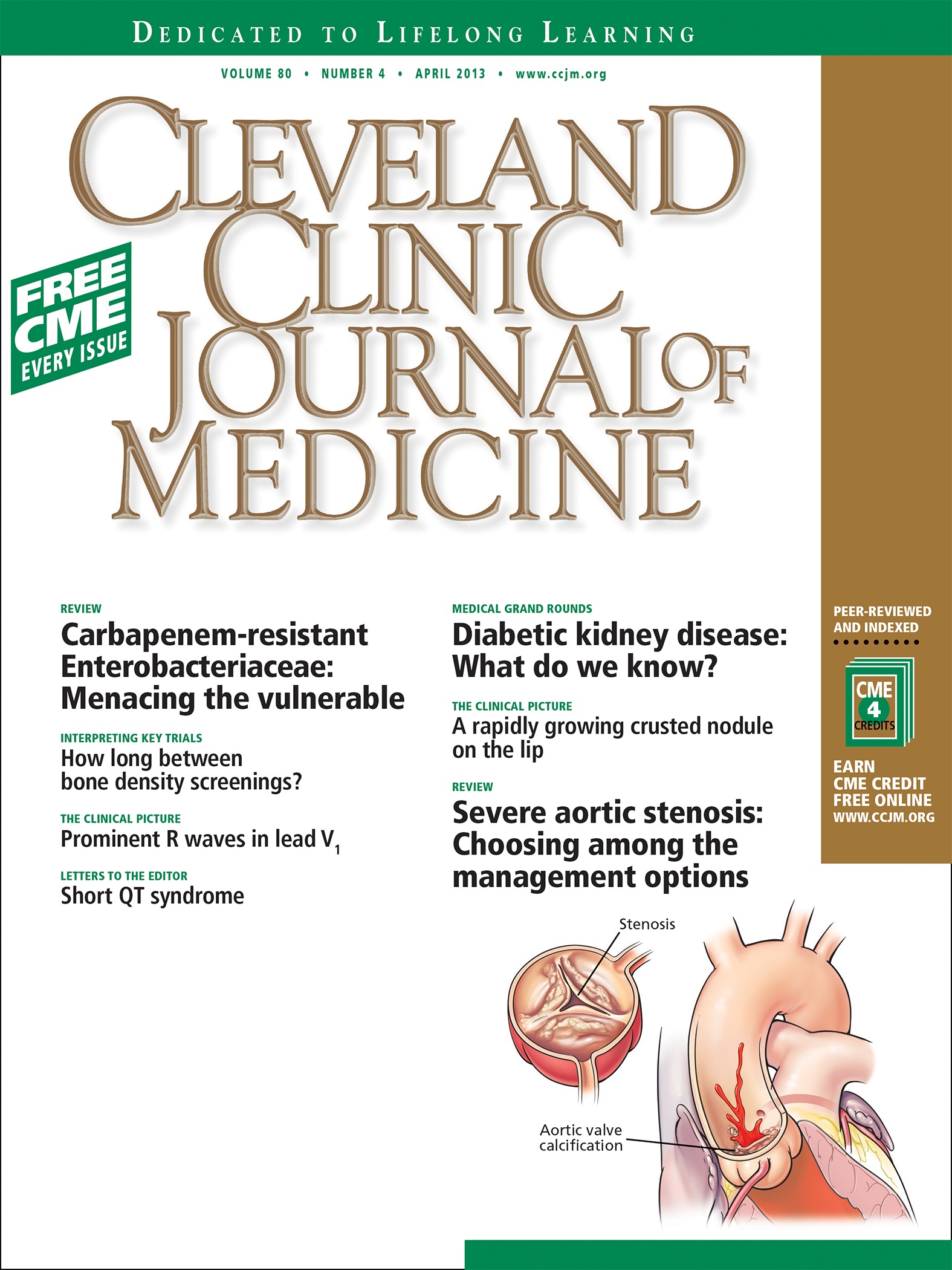 Implications of a prominent R wave in V1 | Cleveland Clinic Journal of ...
