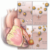 Familial hypercholesterolemia: Detect, treat, and ask about family