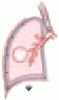 Auto-positive end-expiratory pressure: Mechanisms and treatment